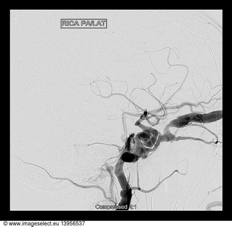 Carotid Cavernous Sinus Fistula Carotid Cavernous Sinus Fistula