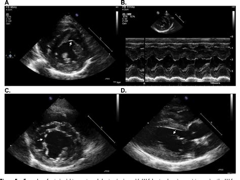 Figure From Screening For Hypertrophic Cardiomyopathy In Cats