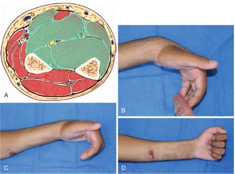 Contractura De Volkmann Academia De Terapia De Manos