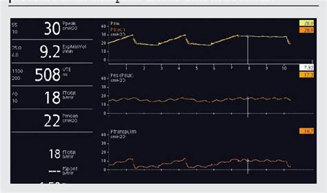 Figure 1 From Esophageal Pressure Balloon And Transpulmonary Pressure