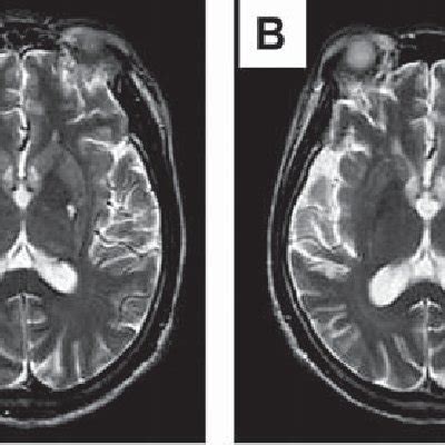 Brain MRI of Case 2 taken right before (A) and 4 months after (B ...