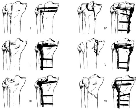 Schatzker classification of tibial plateau fractures • LITFL • Eponym