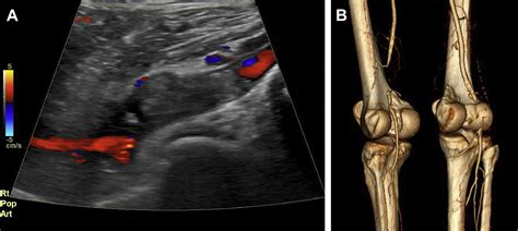 Acute Infection Of Viabahn Stent Graft In The Popliteal Artery