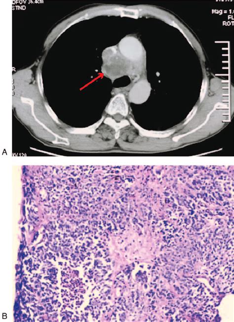 A Chest Ct Scan Showed A Mass In The Right Anterior Upper Mediastinum