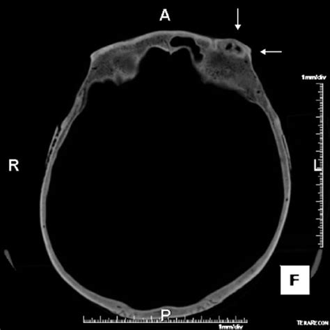 Inferior aspect of the left orbital roof. The supraorbital margin... | Download Scientific Diagram