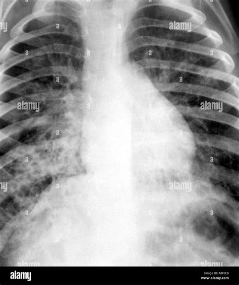 Chest X Ray Cystic Fibrosis Black And White Stock Photos Images Alamy