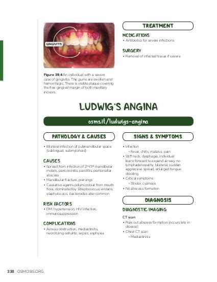 Ludwigs Angina Anatomy