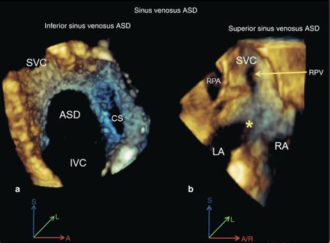 Clinical Applications Of Three Dimensional Transesophageal