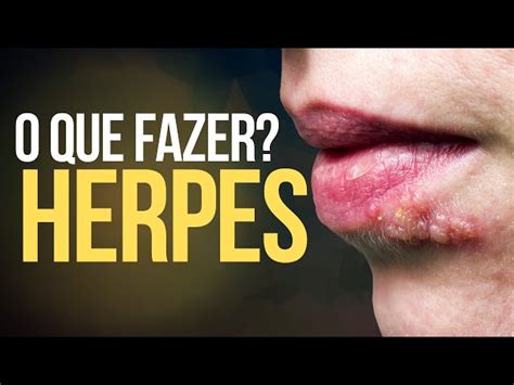 O Que Passar Em Herpes Labial - Herpes Nos Labios Tratamiento Eficaz Para Herpes Labiales: Guía
