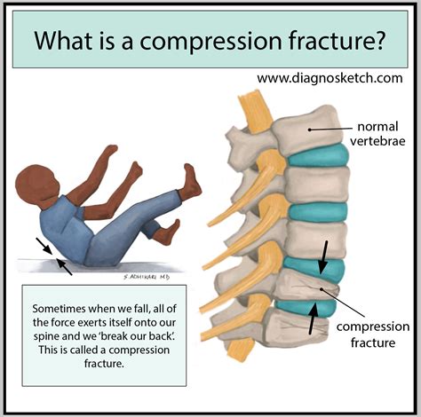 What Is A Compression Fracture By Sapana Adhikari Md