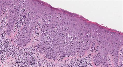 Mycosis fungoides | Ottawa Atlas of Pathology