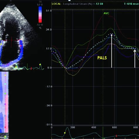 Left Atrial Longitudinal Strain Parameters Composite Figure Showing Download Scientific