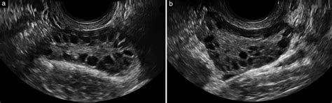 Normal Vs Polycystic Ovaries Ultrasound