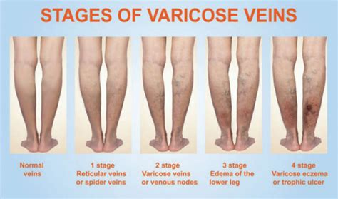 Full Range Of Wound Caretreating Varicose Veins Vein Clinics Of Lake