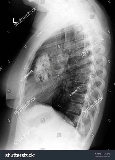 Chest Xray Image Shows Lung Cancer Stock Photo 444367840 Shutterstock