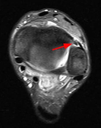 Anterior Tibiofibular Ligament Tear