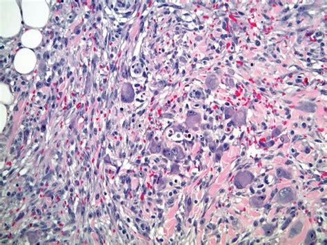 Soft tissue neoplasms - Clinical Tree