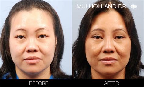 Asian Blepharoplasty Archives Spamedica