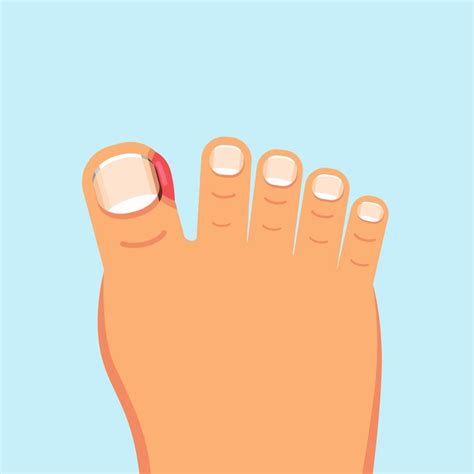 Ingrown Nail Onychocryptosis Nail Disease Flat Vector Illustration