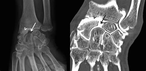 Entorses Du Poignet L Sions Ligamentaires Clinique Ost O