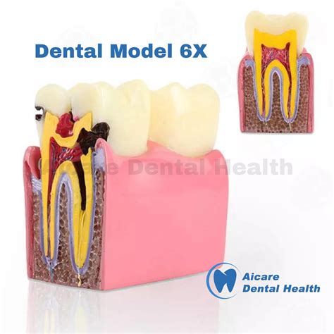 Jual Dental Model 6X Tooth Decay 2 Side Model Gigi Karies 6X 2 Sisi