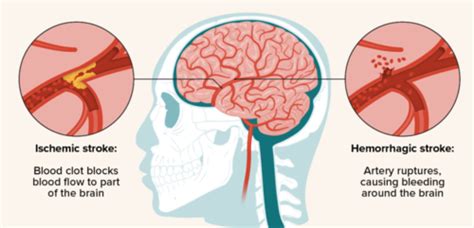 Stroke Eval Dx Prognosis Flashcards Quizlet