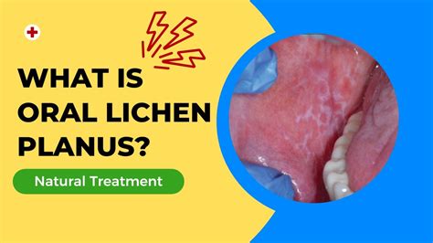 What Is Oral Lichen Planus Homeopathy Treatment Of Oral Lichen Planus