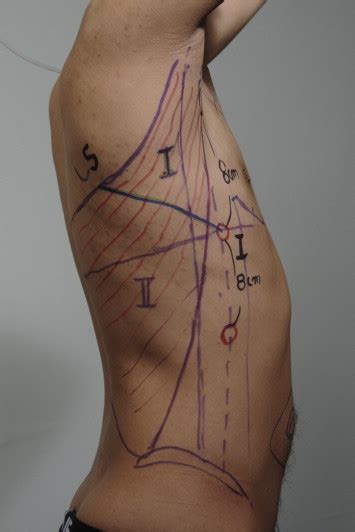 A Novel Technique For Robot Assisted Latissimus Dorsi Flap Harvest