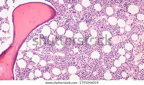 Photomicrograph Showing Histology A Bone Marrow Biopsy With Cellular