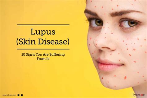 Lupus Symptoms Dry Lips | Lipstutorial.org