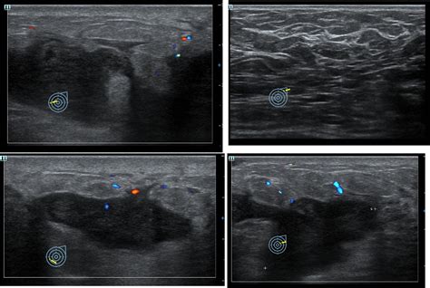 Granulomatous Mastitis Radiology Cases