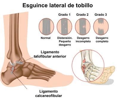 Descubrir 87 Imagen Receta Para Esguince De Tobillo Abzlocal Mx