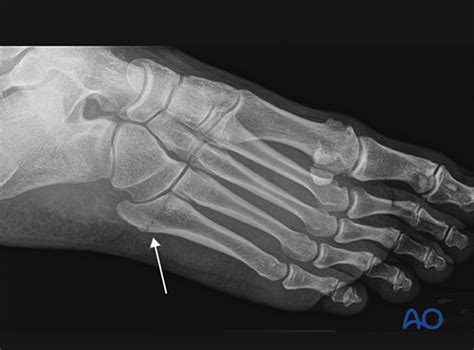 Proximal Articular Fractures Of The 5th Metatarsal Jones Fracture