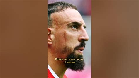 Por Que O Ribery Tem Uma Cicatriz No Rosto Shorts Youtube