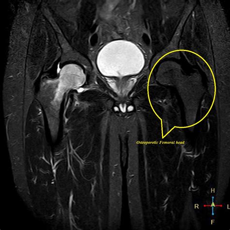 Osteoporosis Knee X Ray