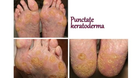 Palmoplantar Keratodermas