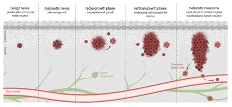 4 Melanoma Development Melanoma Development Is A Multistep Process