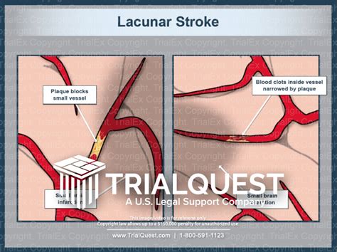 Lacunar Stroke - Trial Exhibits Inc.