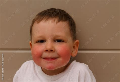 The Boy Has Red Cheeks A Rash On His Cheeks In The Child A Rash On