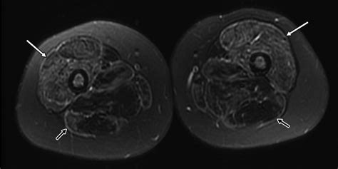 Juvenile Dermatomyositis Correlation Of Mri At Presentation With