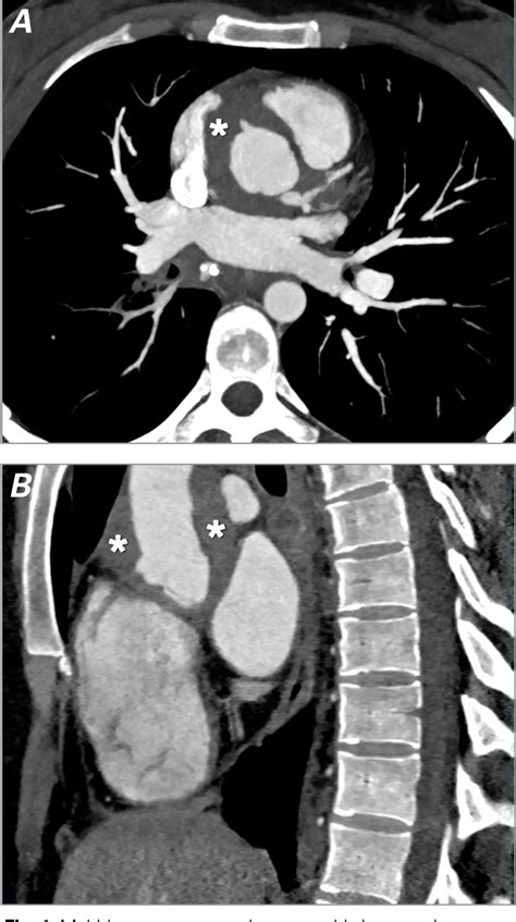 Figure From Multidetector Computed Tomographic Imaging Of Erdheim