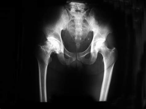 DePuy Hip Replacement Recall Reaches 2 Year Anniversary - Strom Law Firm