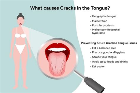 Premium Vector | Causes cracks in tongue medical information