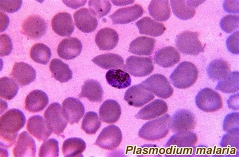 Top 12 Diseases Caused By Protozoa Malaria Trypanosomiasis And More