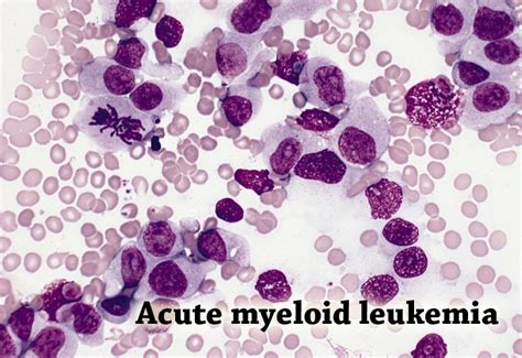 Acute Myelogenous Leukemia