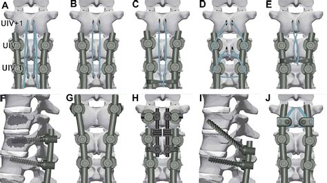 Proximal Junctional Kyphosis And Failure Strategies For Prevention