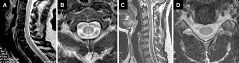 Scielo Brasil Magnetic Resonance Findings In Subacute Combined