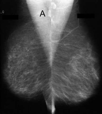 Med Dx Breast Imaging Flashcards Quizlet