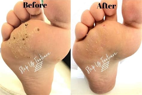 Plantar Wart Treatment Podiatrist Nyc Downtown Step Up Footcare