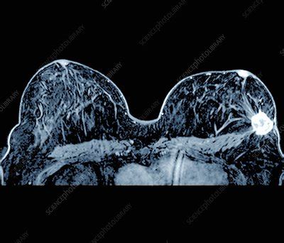 Breast cancer, MRI scan - Stock Image - C026/9992 - Science Photo Library